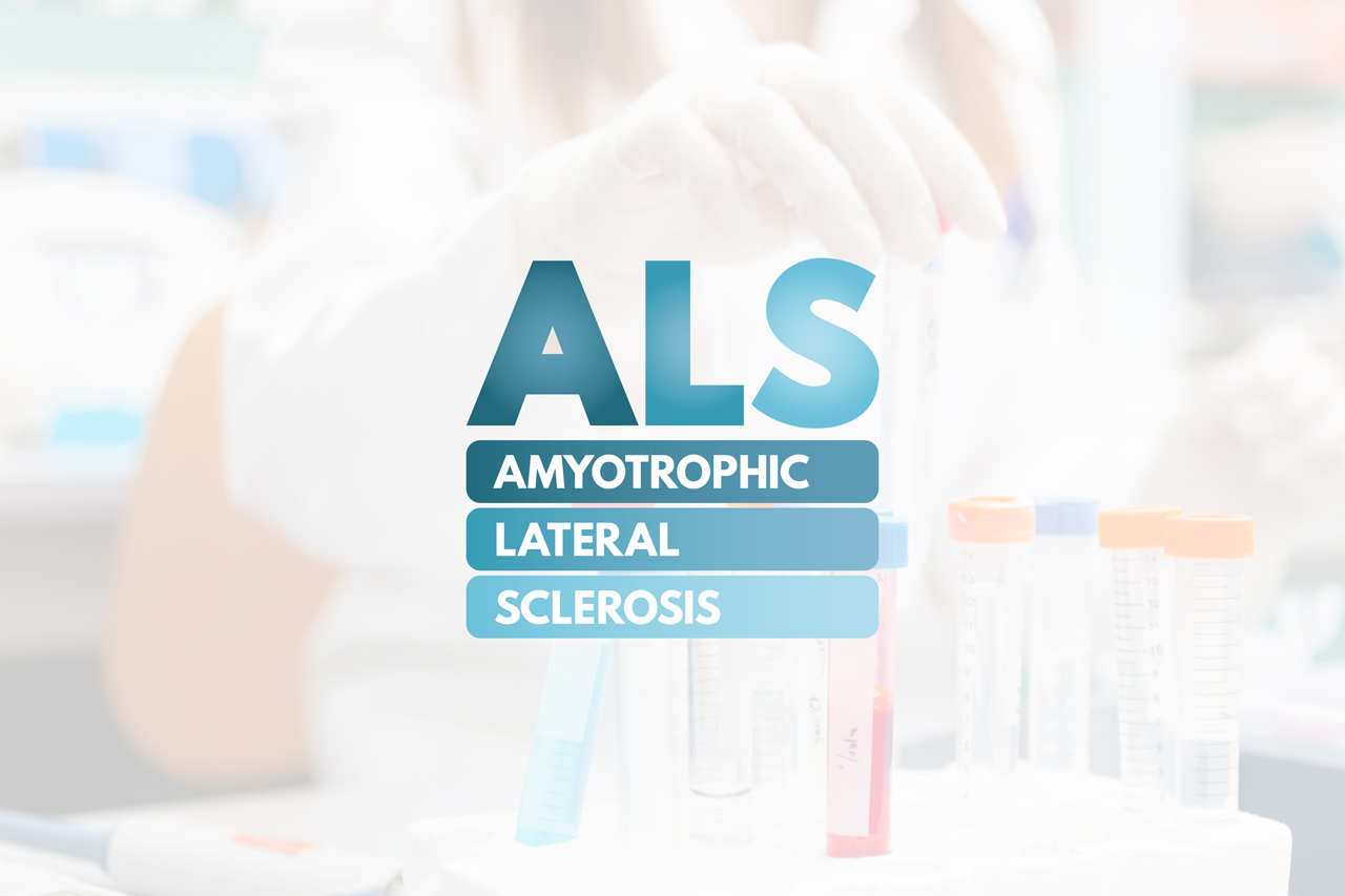 Can an ASO Reduce Disease Progression in ALS?